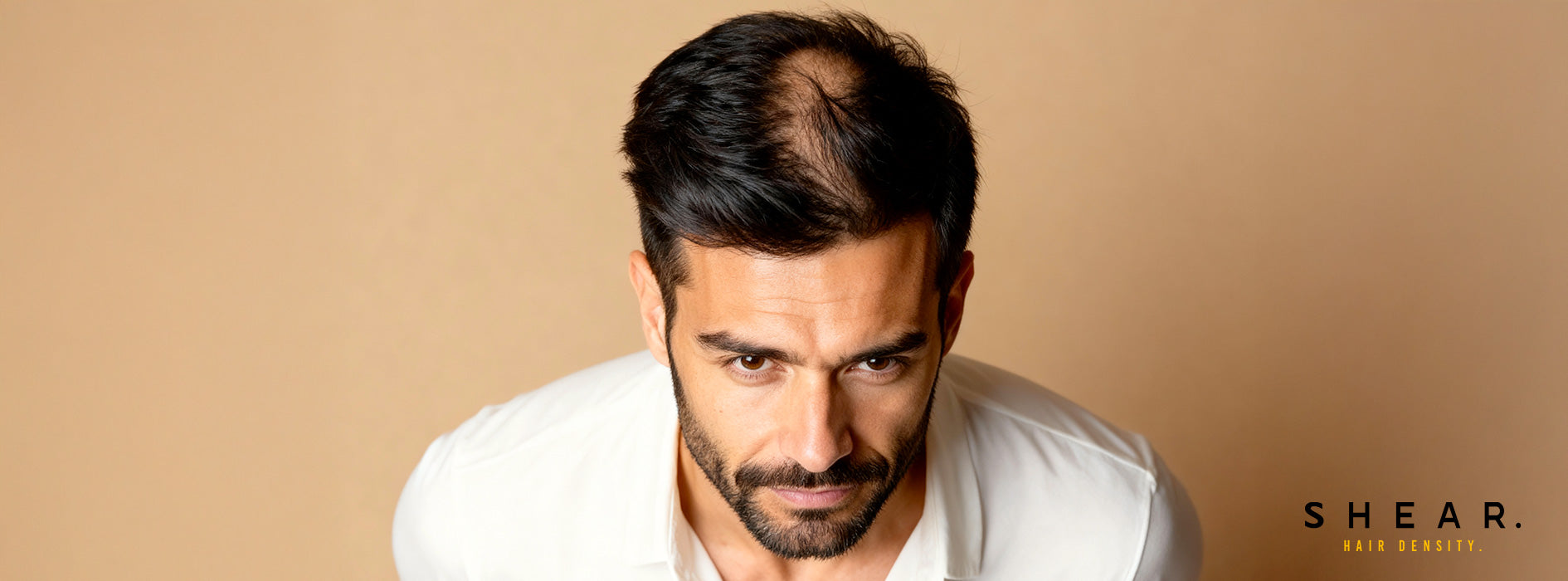 Résultat avant utilisation des produits capillaires SHEAR – cuir chevelu clairsemé avant correction